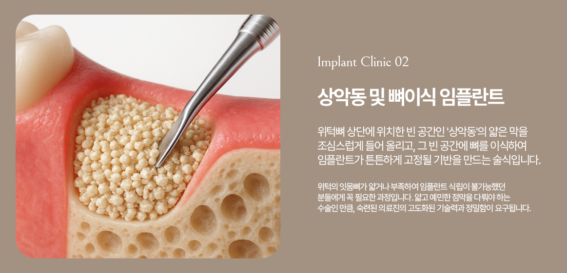 옥정온가족치과 상악동 뼈이식 임플란트 안내