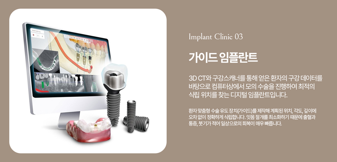 옥정온가족치과 가이드 임플란트 안내