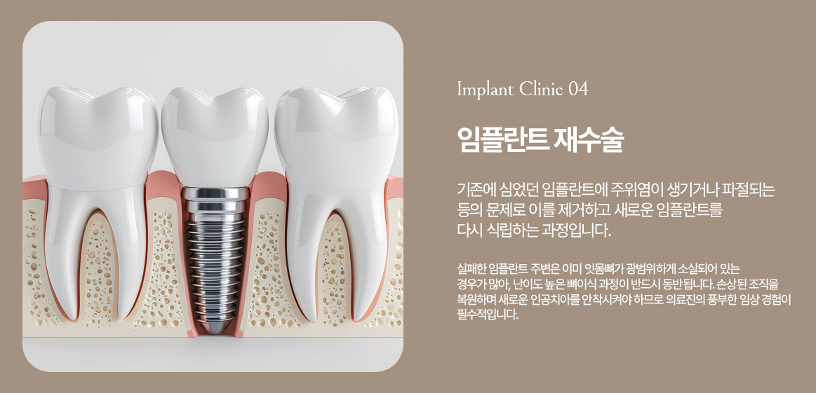 옥정온가족치과 임플란트 재수술 안내
