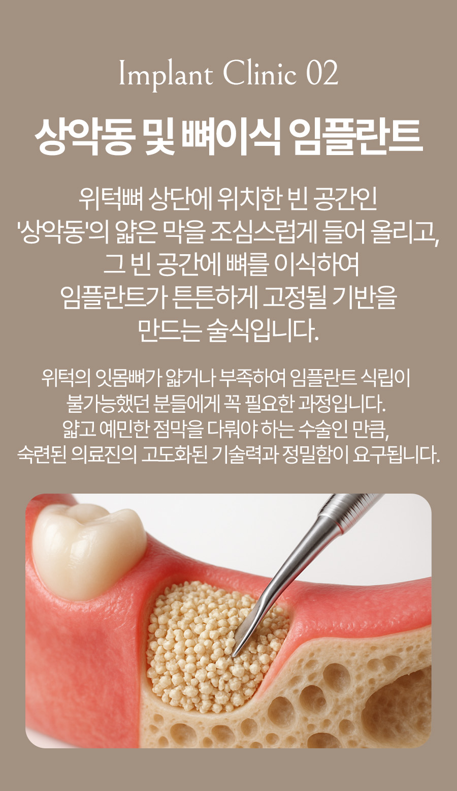 옥정온가족치과 상악동 뼈이식 임플란트 안내