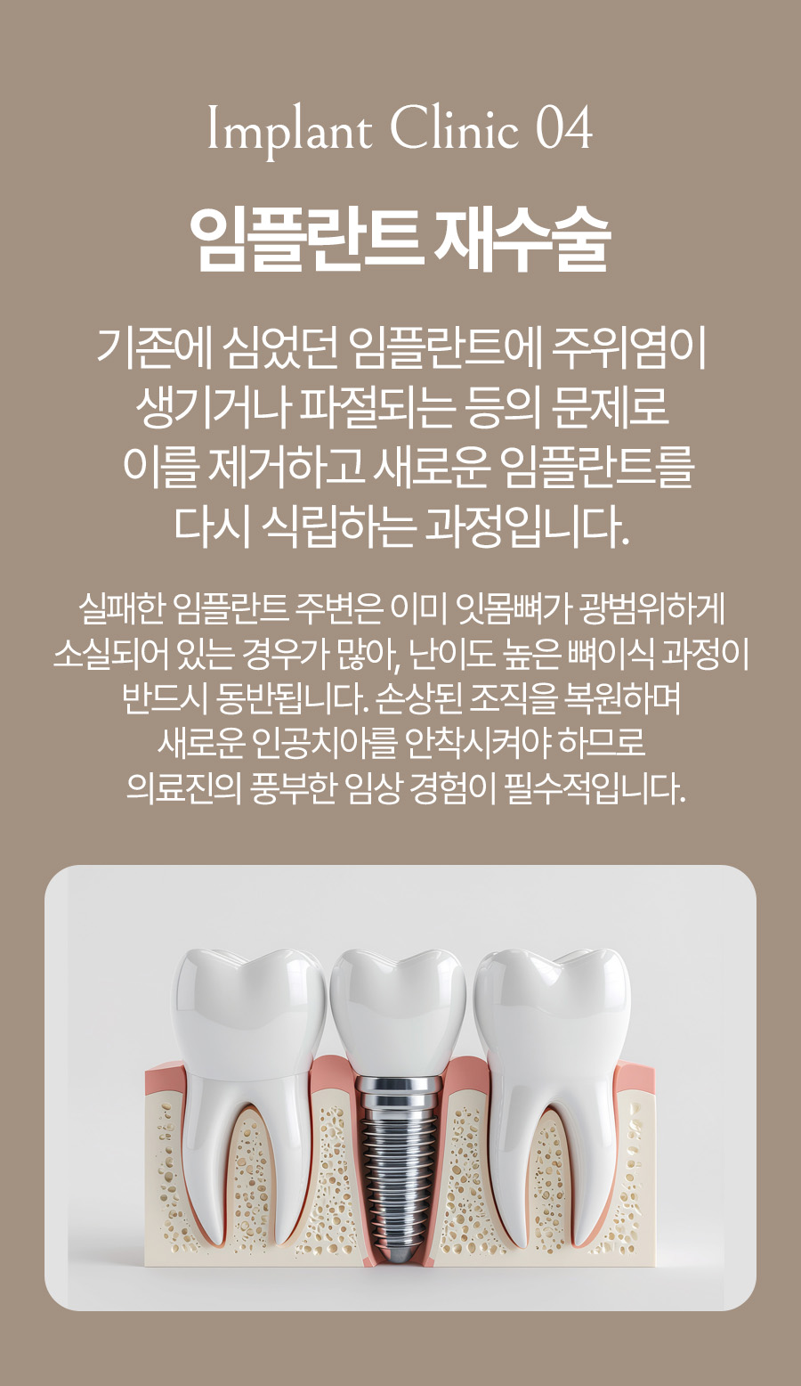 옥정온가족치과 임플란트 재수술 안내